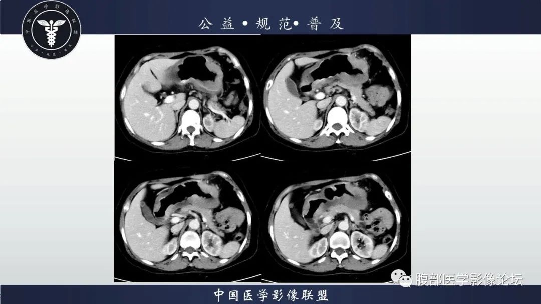 【病例】淋巴瘤与胃癌各1例CT影像