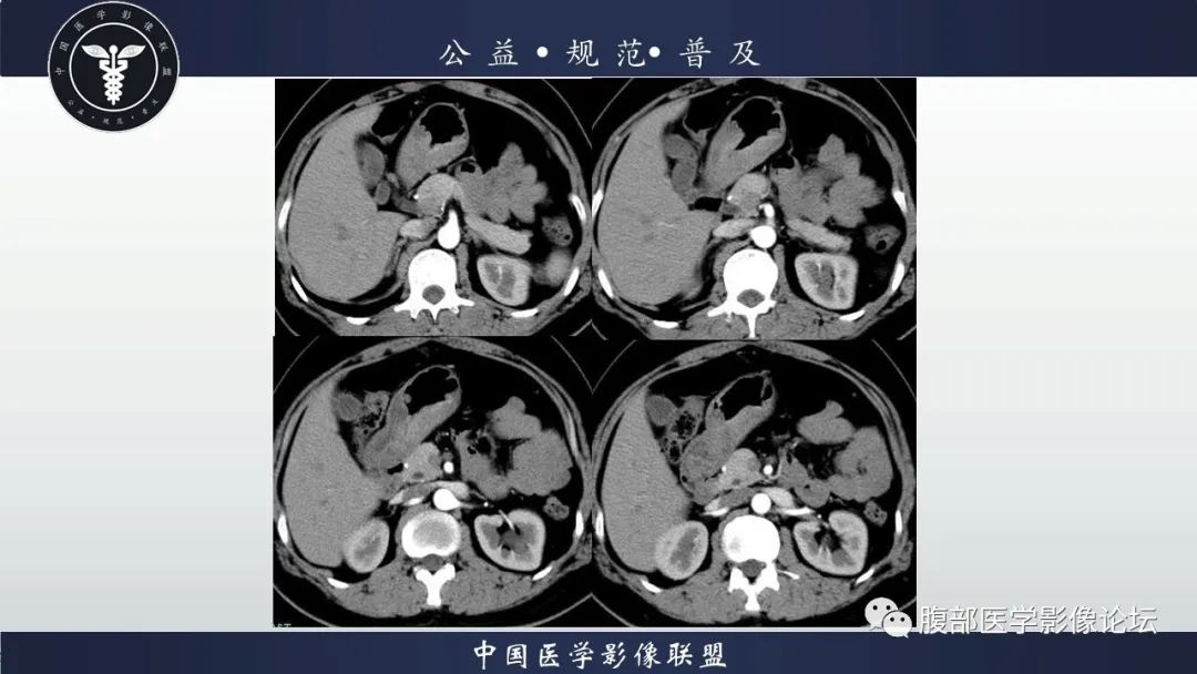 【病例】淋巴瘤与胃癌各1例CT影像