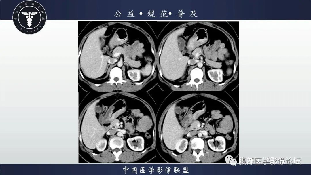 【病例】淋巴瘤与胃癌各1例CT影像