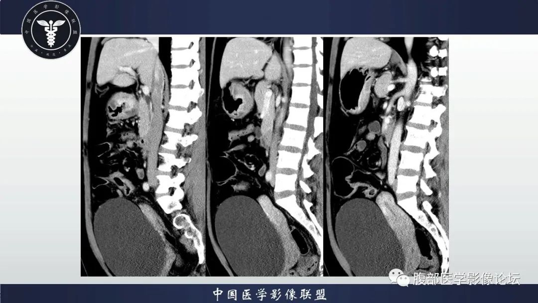 【病例】淋巴瘤与胃癌各1例CT影像