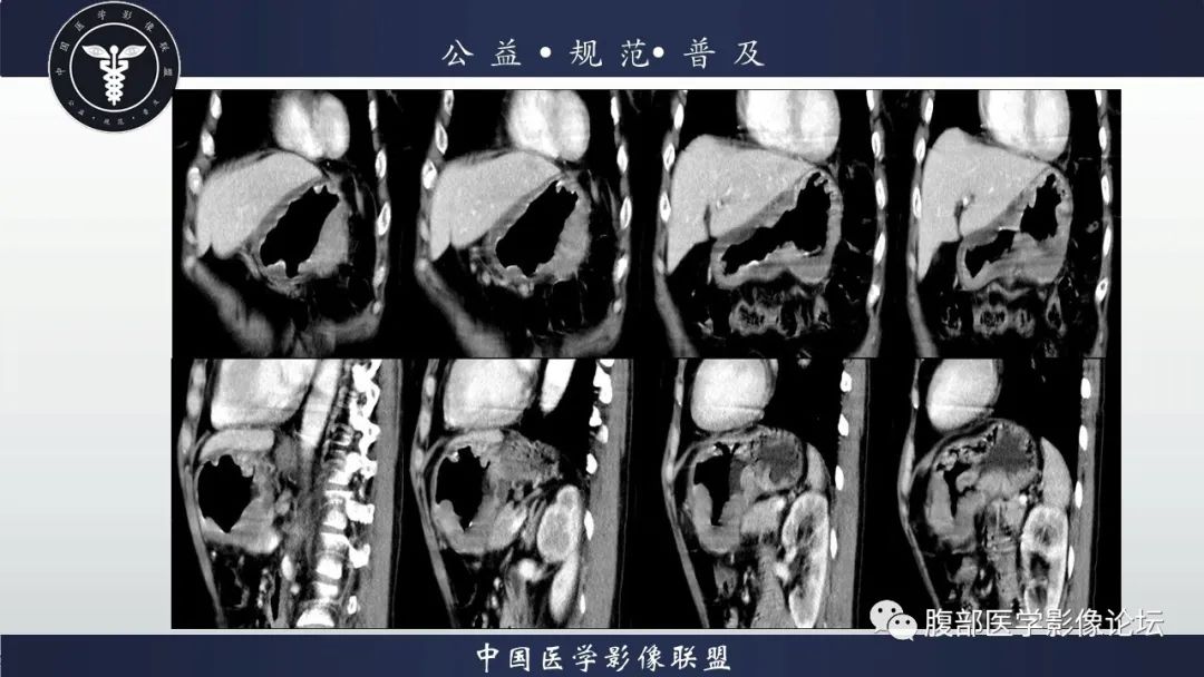 【病例】淋巴瘤与胃癌各1例CT影像 【病例】淋巴瘤与胃癌各1例CT影像