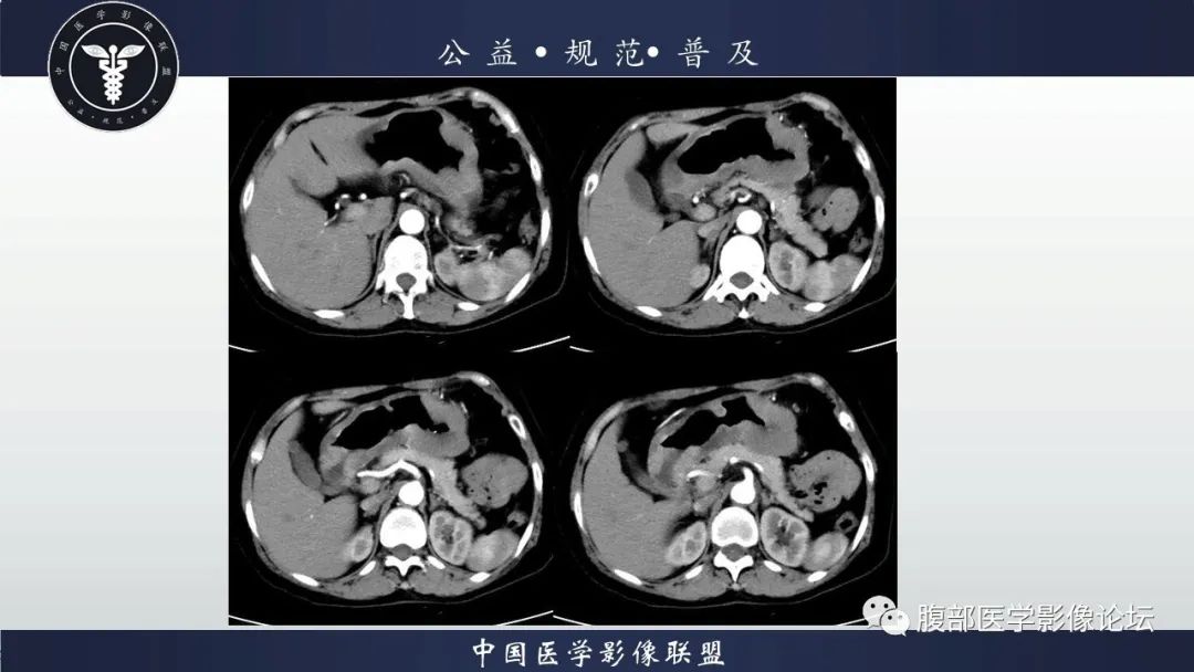 【病例】淋巴瘤与胃癌各1例CT影像