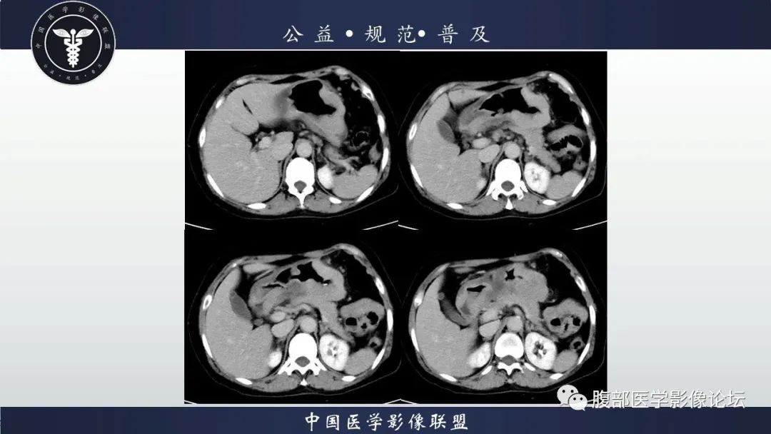 【病例】淋巴瘤与胃癌各1例CT影像