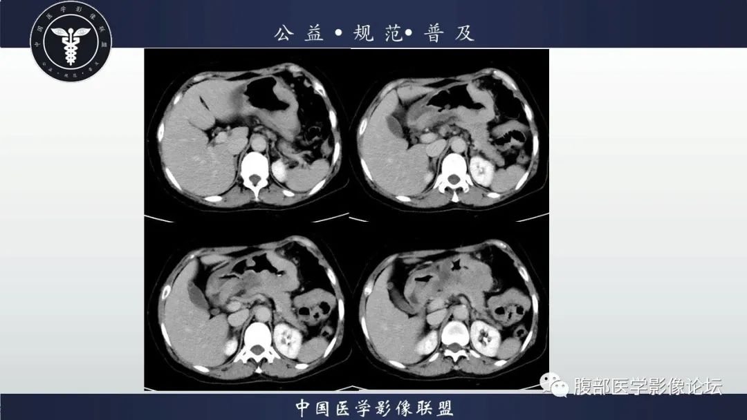 【病例】淋巴瘤与胃癌各1例CT影像