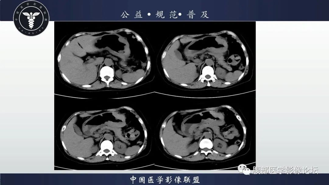 【病例】淋巴瘤与胃癌各1例CT影像