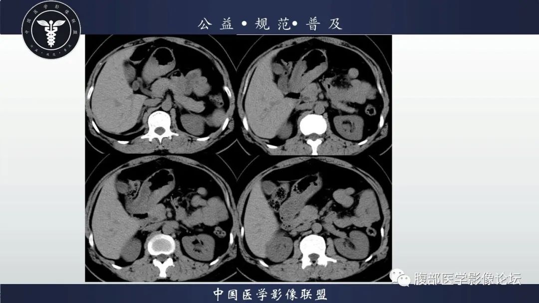 【病例】淋巴瘤与胃癌各1例CT影像