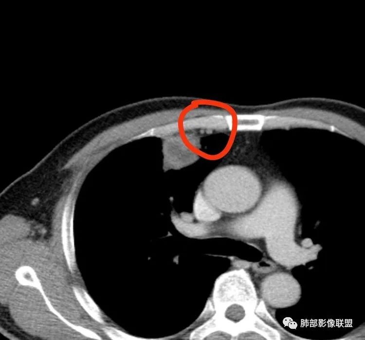 【病例】良恶一念间——肺部病变分析1例