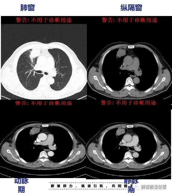 【病例】良恶一念间——肺部病变分析1例