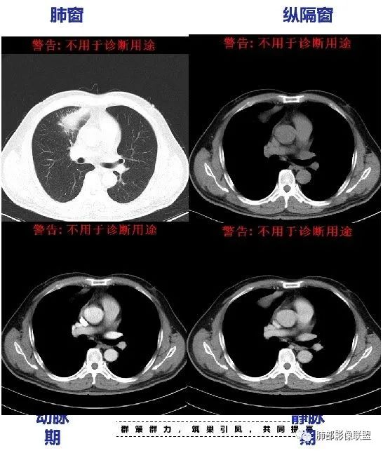 【病例】良恶一念间——肺部病变分析1例