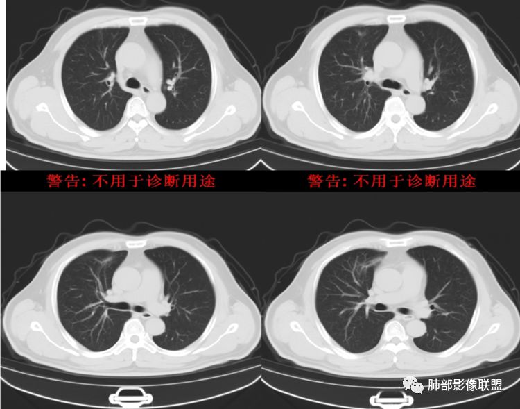 【病例】良恶一念间——肺部病变分析1例