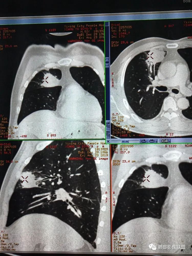 【病例】良恶一念间——肺部病变分析1例