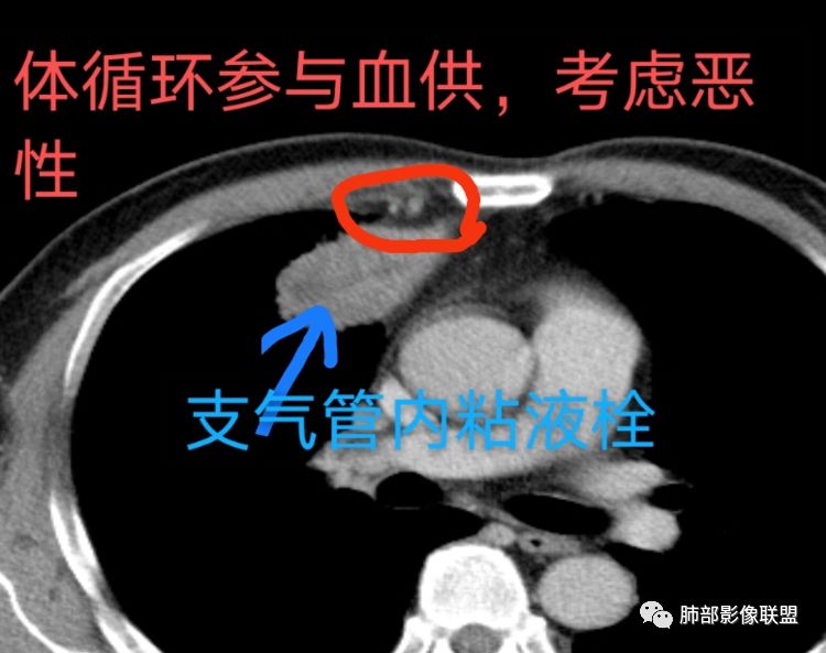 【病例】良恶一念间——肺部病变分析1例