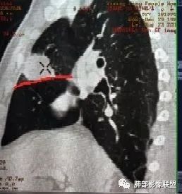 【病例】良恶一念间——肺部病变分析1例