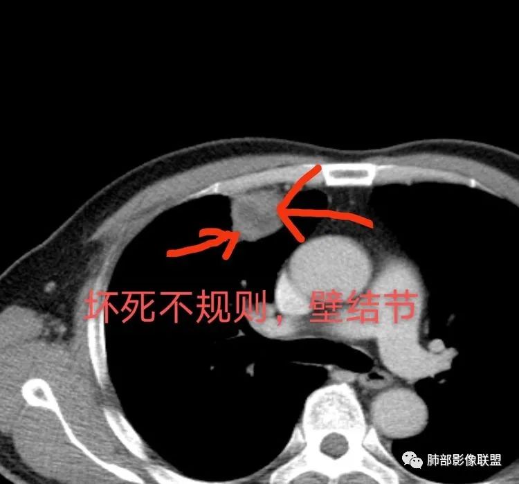 【病例】良恶一念间——肺部病变分析1例