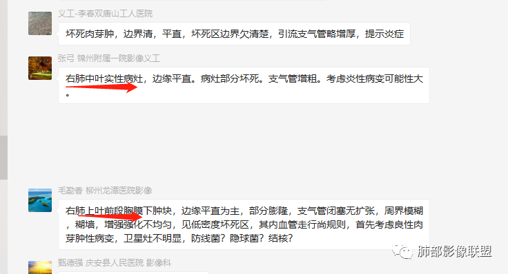 【病例】良恶一念间——肺部病变分析1例