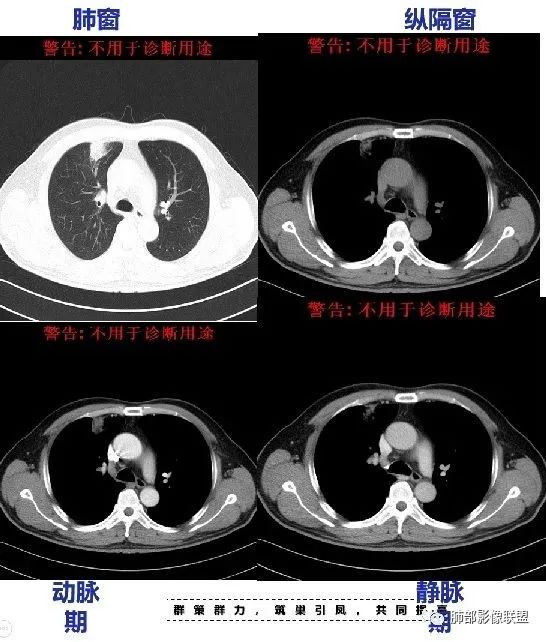 【病例】良恶一念间——肺部病变分析1例