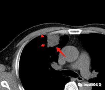 【病例】良恶一念间——肺部病变分析1例