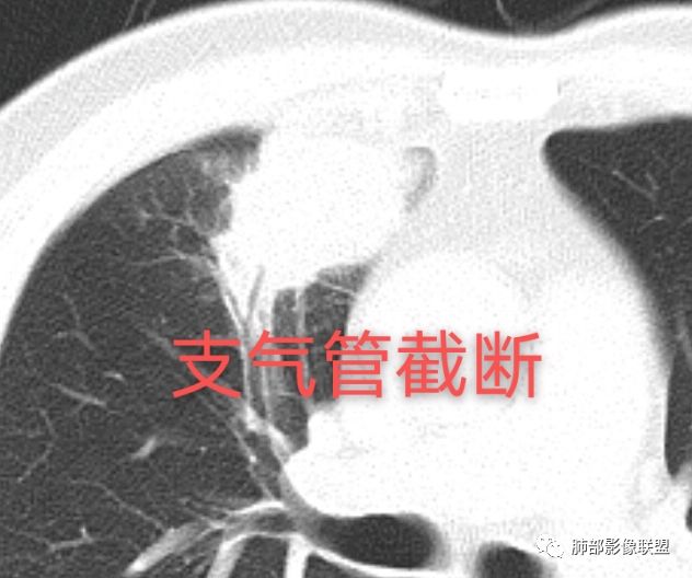 【病例】良恶一念间——肺部病变分析1例