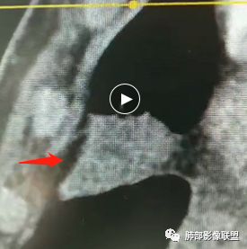 【病例】良恶一念间——肺部病变分析1例