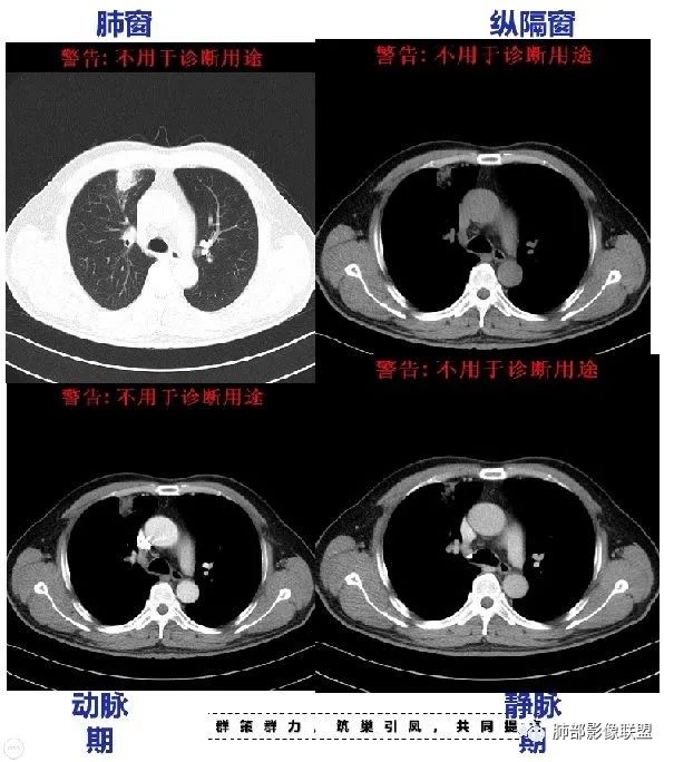 【病例】良恶一念间——肺部病变分析1例