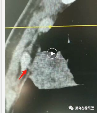 【病例】良恶一念间——肺部病变分析1例