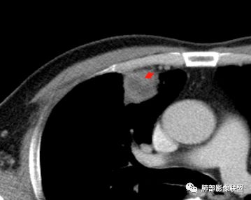 【病例】良恶一念间——肺部病变分析1例