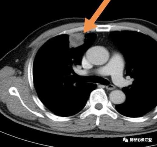 【病例】良恶一念间——肺部病变分析1例