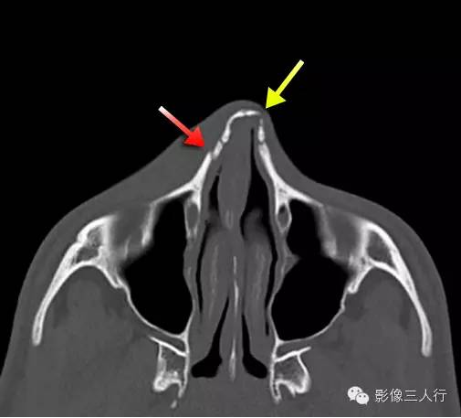 鼻骨解剖及鼻骨骨折
