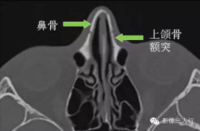 鼻骨解剖及鼻骨骨折