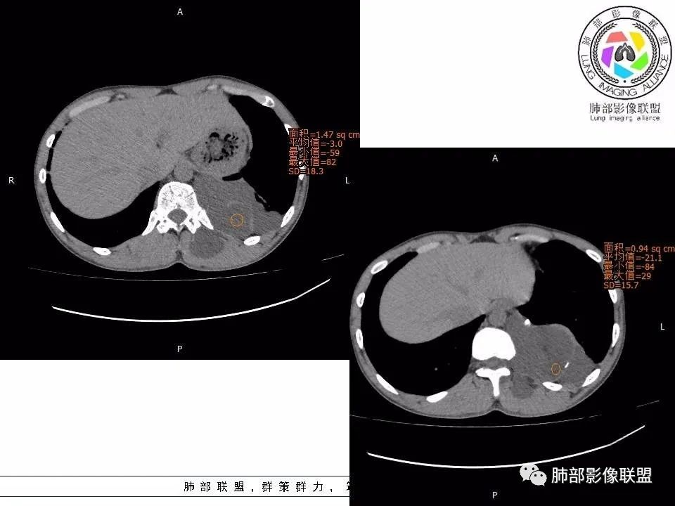 【病例】冬眠瘤一例影像讨论