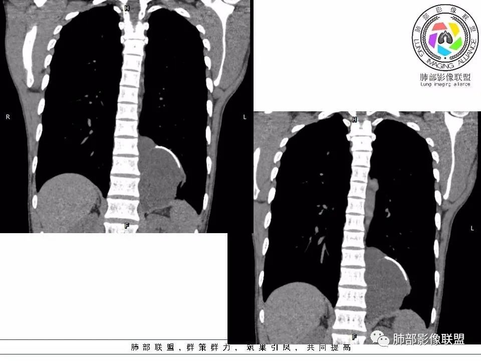 【病例】冬眠瘤一例影像讨论