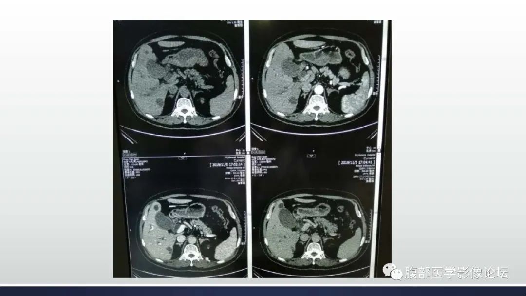 【病例】胰腺癌1例CT影像