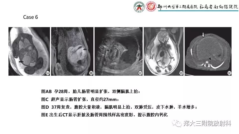 【PPT】胎儿水肿综合征