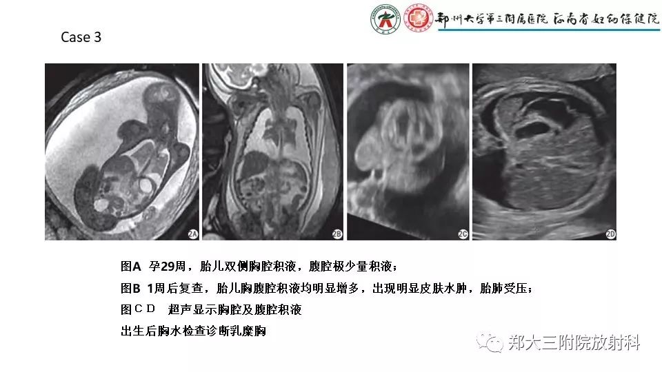 【PPT】胎儿水肿综合征