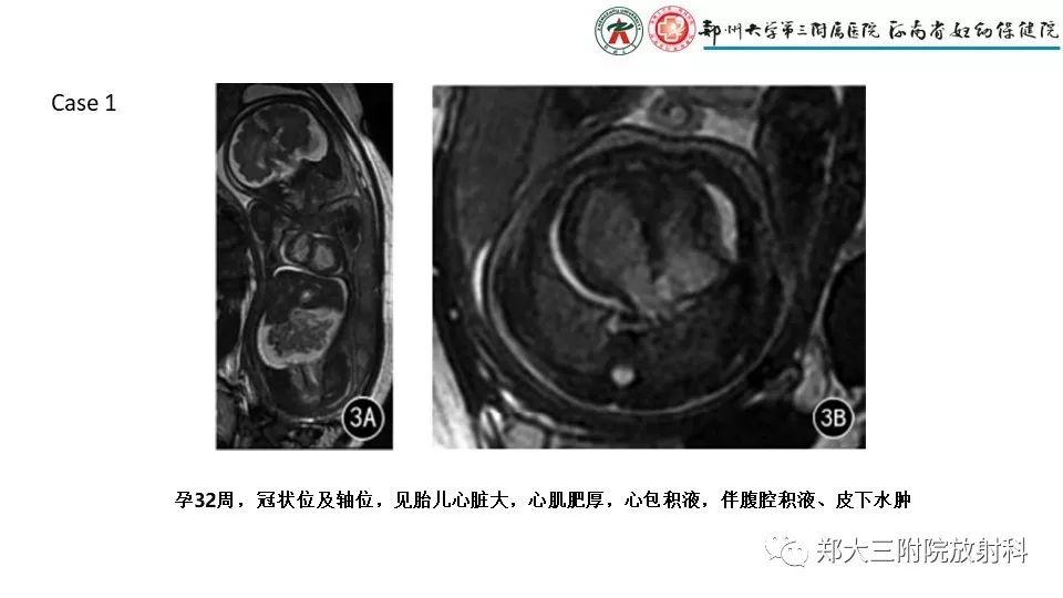 【PPT】胎儿水肿综合征