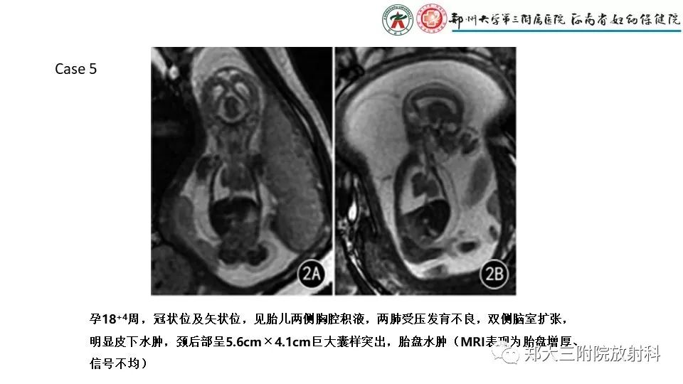 【PPT】胎儿水肿综合征