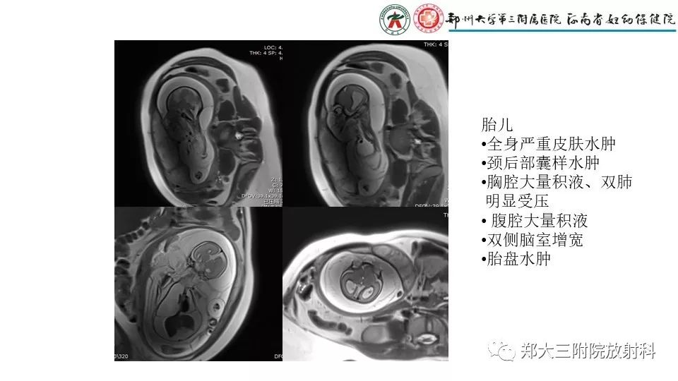 【PPT】胎儿水肿综合征