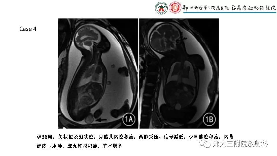 【PPT】胎儿水肿综合征