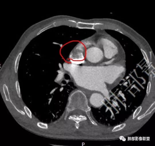【病例】心脏血管肉瘤1例CT影像