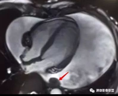 【病例】心包恶性间皮瘤1例CT影像