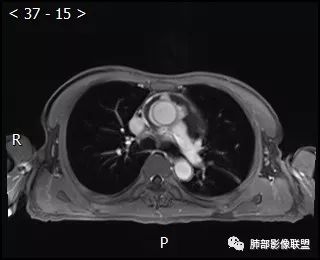 【病例】心包恶性间皮瘤1例CT影像