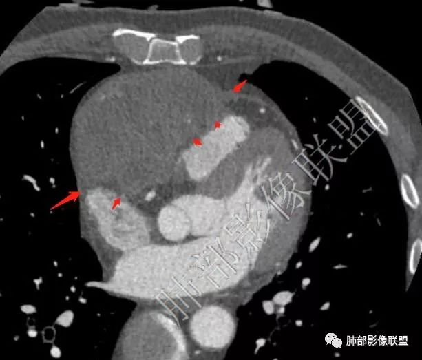 【病例】心包恶性间皮瘤1例CT影像
