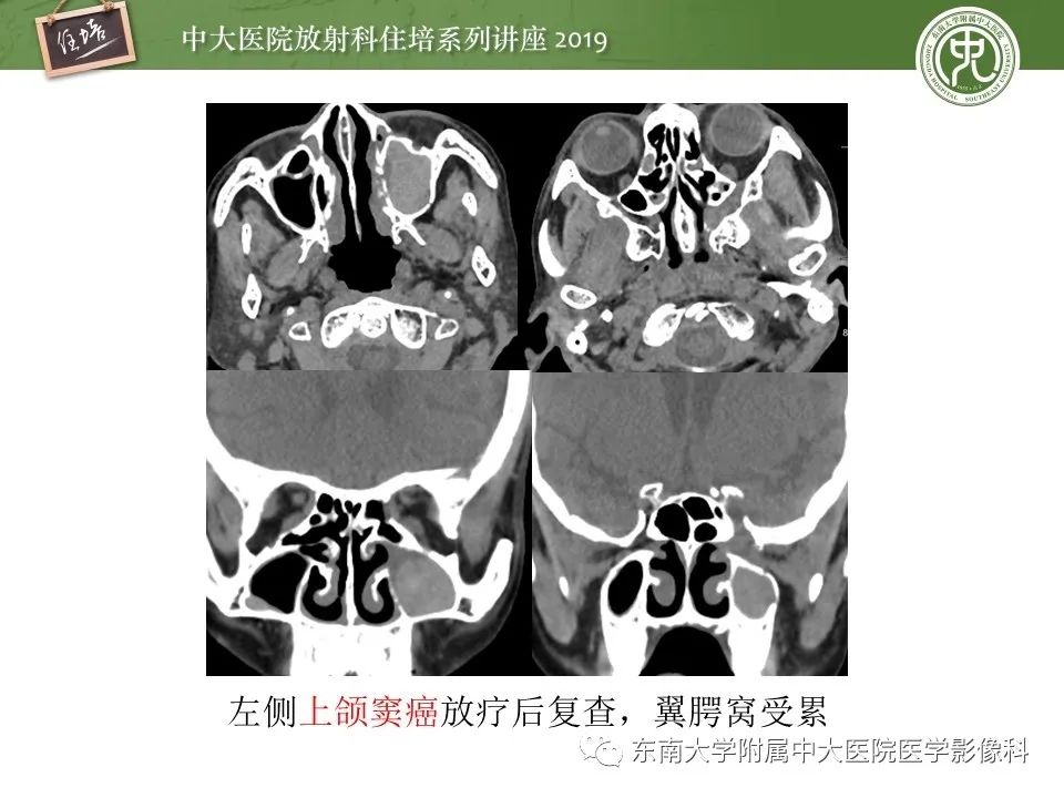 【PPT】翼腭窝的影像解剖及临床意义