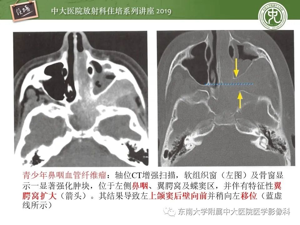 【PPT】翼腭窝的影像解剖及临床意义