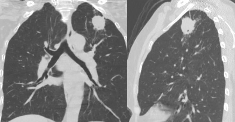 胸膜解剖及胸膜孤立性纤维瘤的 CT 诊断