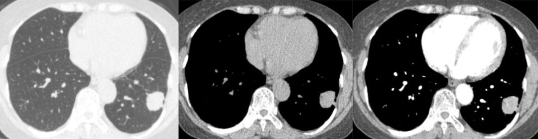 胸膜解剖及胸膜孤立性纤维瘤的 CT 诊断
