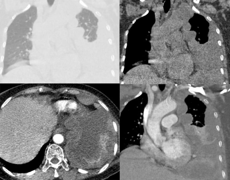 胸膜解剖及胸膜孤立性纤维瘤的 CT 诊断