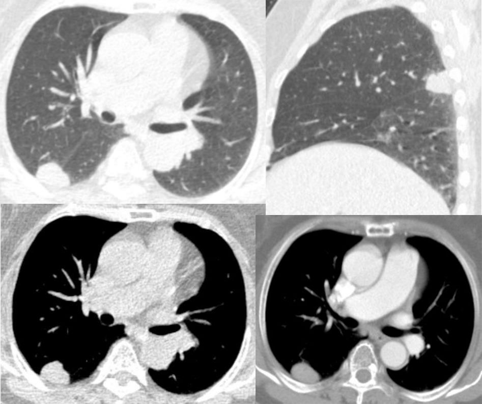 胸膜解剖及胸膜孤立性纤维瘤的 CT 诊断