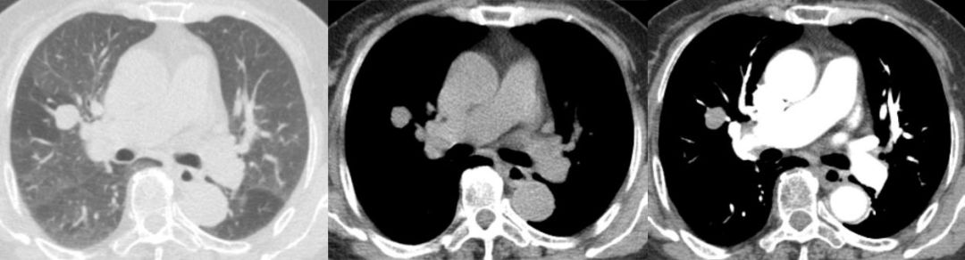 胸膜解剖及胸膜孤立性纤维瘤的 CT 诊断