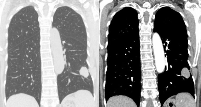 胸膜解剖及胸膜孤立性纤维瘤的 CT 诊断
